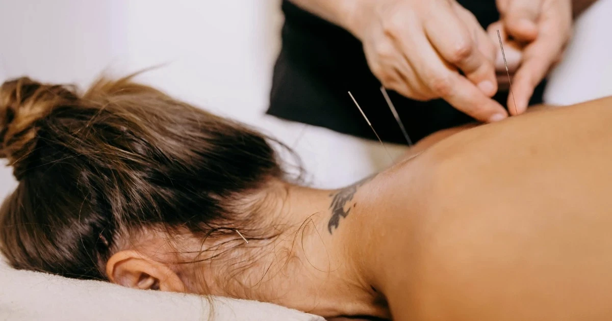 Clinician performing dry needling trigger-point treatment